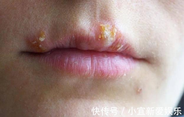 身体|嘴上长泡是身体在排毒吗？或许是暗示了这几个问题，别忽视