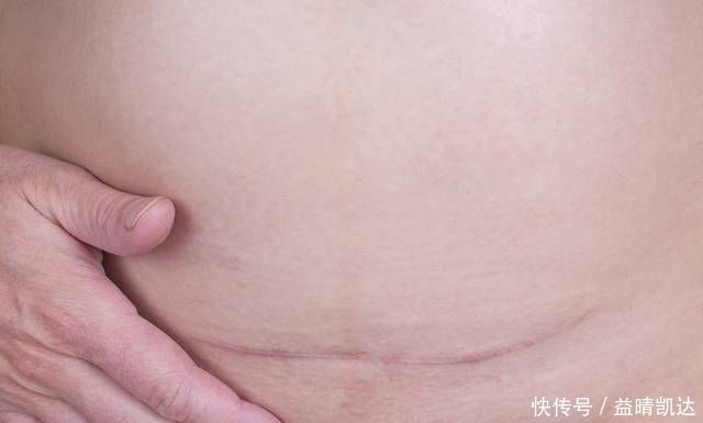 知识|头胎是剖腹产再次怀孕生二胎,这些知识你必须要知道!