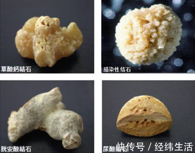 尿路结石|有一种病平时不疼,发作的时候比生孩子还疼,好发于年轻男性