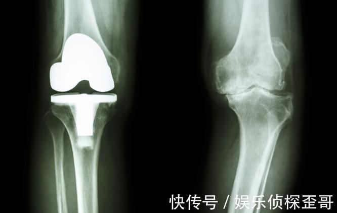 关节炎|晚期关节炎能靠人工关节置换术夺回健康?医生讲明不早用的理由