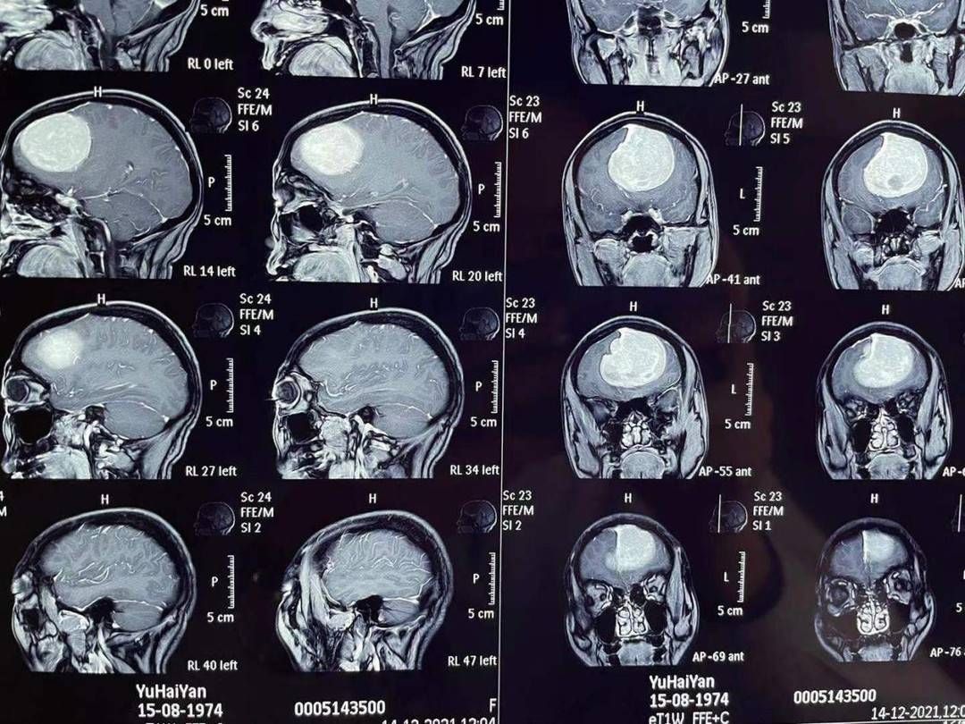 神经外科|女子反复头痛六年 原因竟是脑袋里长了一个拳头大的肿瘤