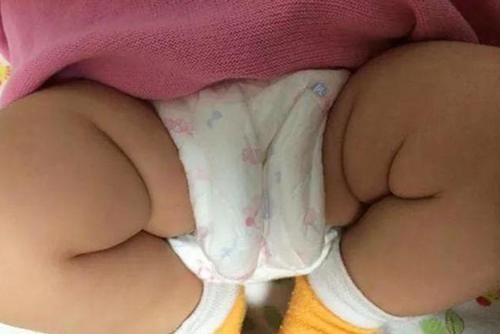 屁蛋|宝宝的臀纹不对称不仅“屁蛋丑”,还有发育隐患,错过难弥补