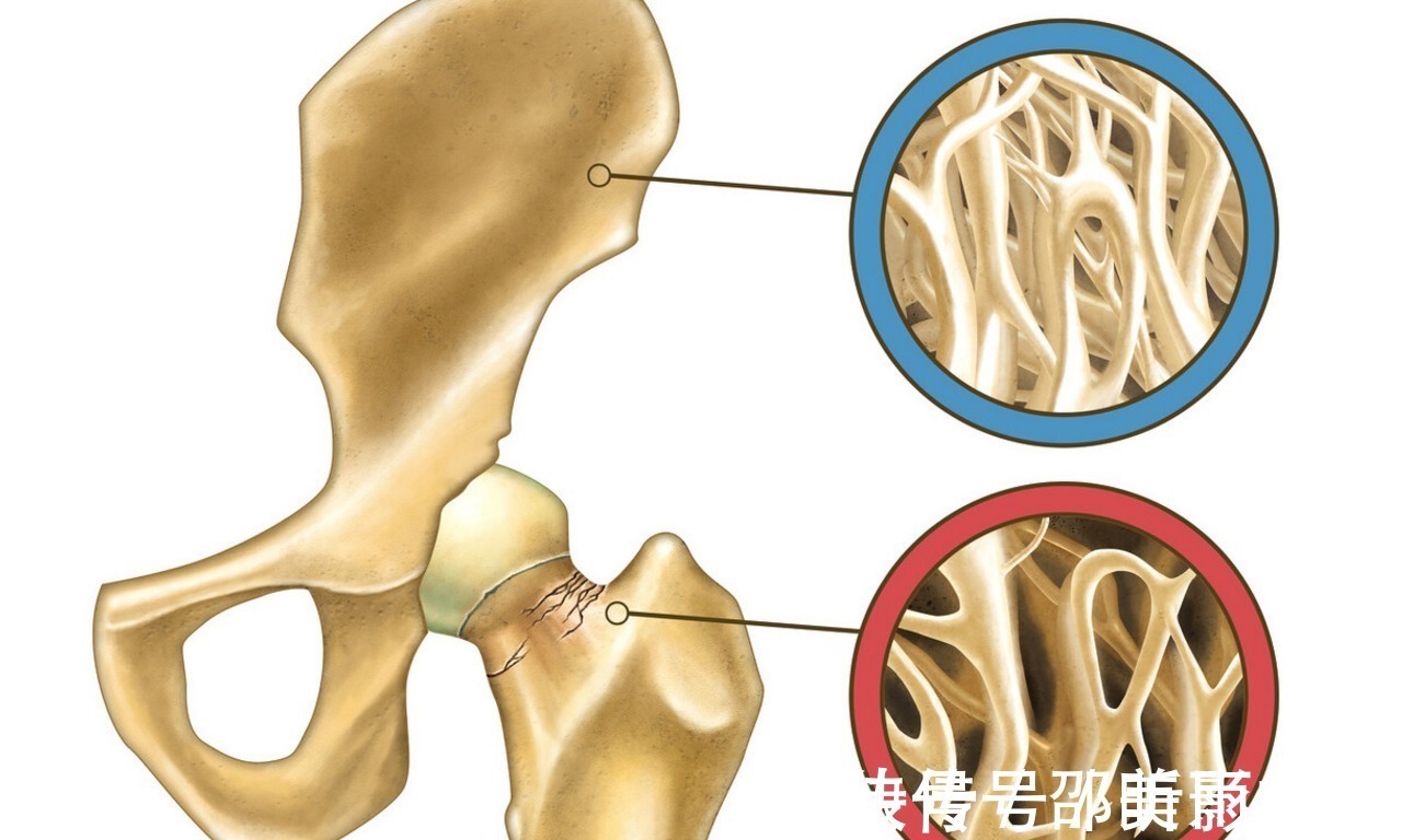 中老年人|骨科专家:1碗白萝卜汤,坚持2个月腰背不疼,骨质疏松和你说再见