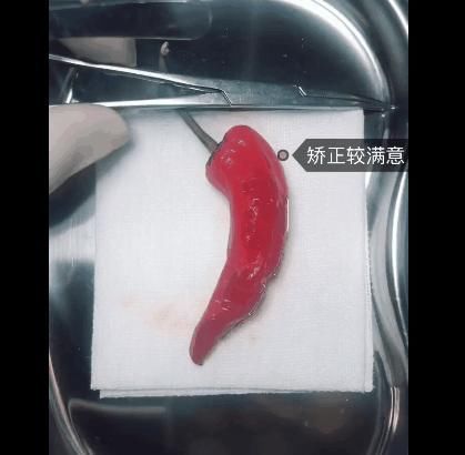 手术|给火龙果割阑尾33岁水果医生爆红吸粉90万网友看到第一个就痛了