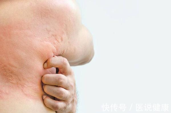 皮肤|皮肤反复出现瘙痒感,要重视,或与这5个因素有关,你需要了解