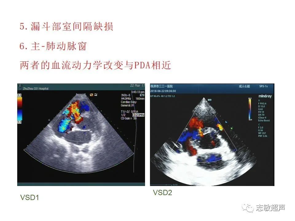 超声|肺动脉瓣周边异常血流的超声鉴别