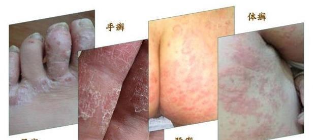 真菌|“脚气”真菌怎么做才能根除?2个简单小方法,彻底治好不复发!