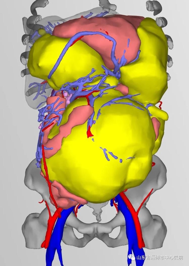 东院区|淄博市中心医院胃肠外科近期再完成一例高难度腹膜后巨大肿瘤手术