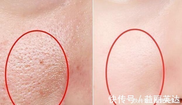 洗面奶|先别慌着挤黑头,这3种原因你知道了再挤也不迟!