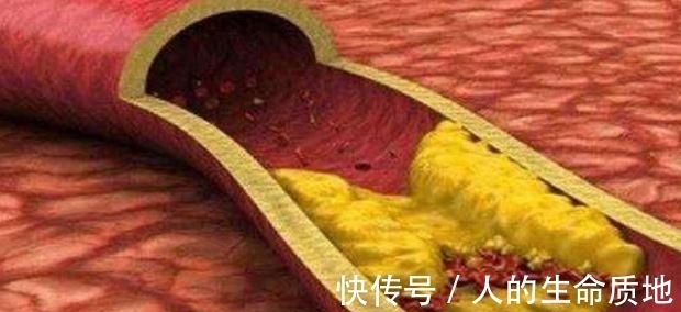 胆固醇|患高血脂的人逐渐增多,不一定跟爱吃肉有关,可能与它也有关系