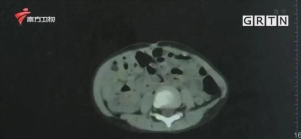 男童|2岁男童体内竟然有3颗肾结石！