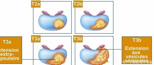 ct检查|为什么医生总是让癌症患者做CT检查?三大作用,你可能不了解