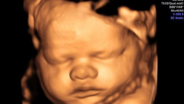 胎儿|孕妈做排畸检查，医生说太胖看不到孩子的脸，孕妈该咋做呢