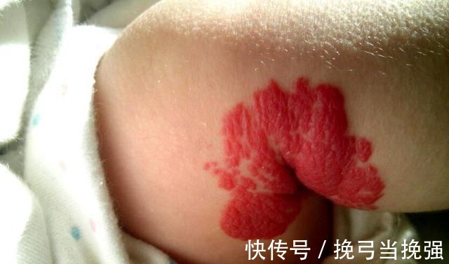 家长|一岁宝宝因“胎记”抢救无效,永远闭上了眼,家长不容忽视!