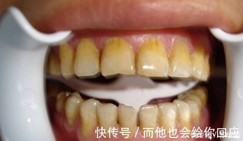 黄牙|牙齿发黄,教你一招,这样做,就能让你一周拥有一口大白牙