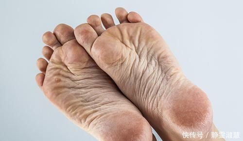 快速治脚气脚脱皮脚痒