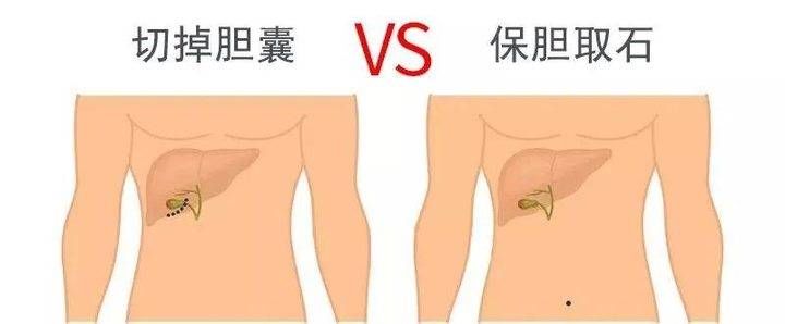  苹果汁|苹果汁能排胆结石？这几个江湖谣言你要分清真假