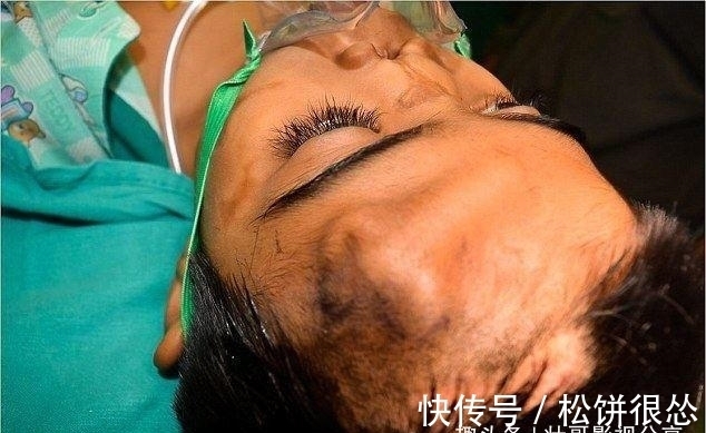 鼻子|国外小男孩鼻子长在额头上,看了他的经历,真是坚强的表率