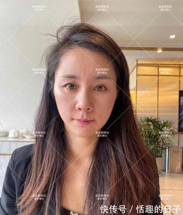 线雕 44岁小拉皮术后5个半月,用亲身经历谈一谈我的感受!