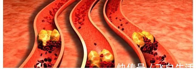 血管堵塞|血脂高的人不能喝牛奶？提醒：甘油三酯高的人，3物才需要远离