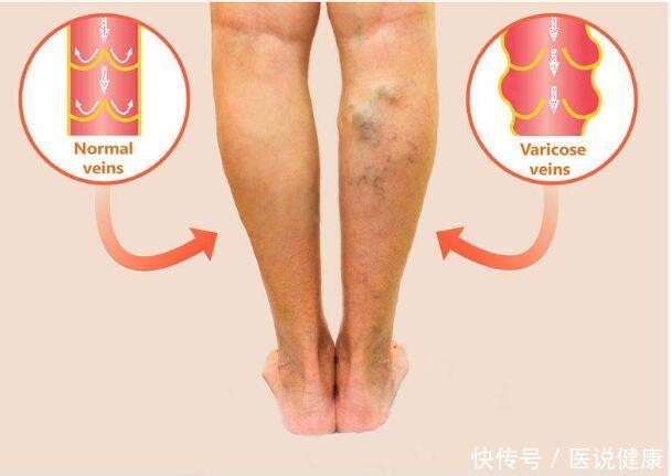  发出|体内有血栓，身体会发出6个信号，及时检查，避免血管堵塞