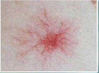 黄曲霉毒素|身体出现“小红点”,八成是肝喊疼了,忠告要忌口