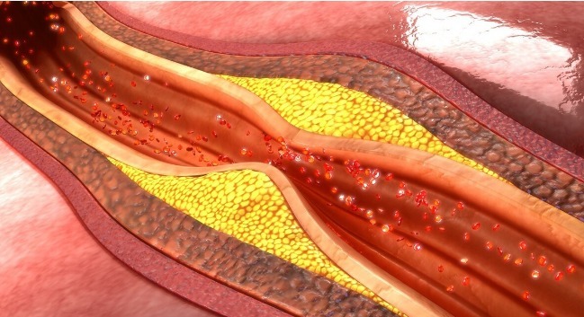 心脑血管|血管堵了,长期吃三七粉和丹参可以吗通血管哪种更好