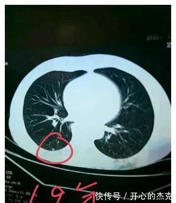 6mm|怀疑肺癌的实性肺结节当地让手术,我回复:信我的,不切