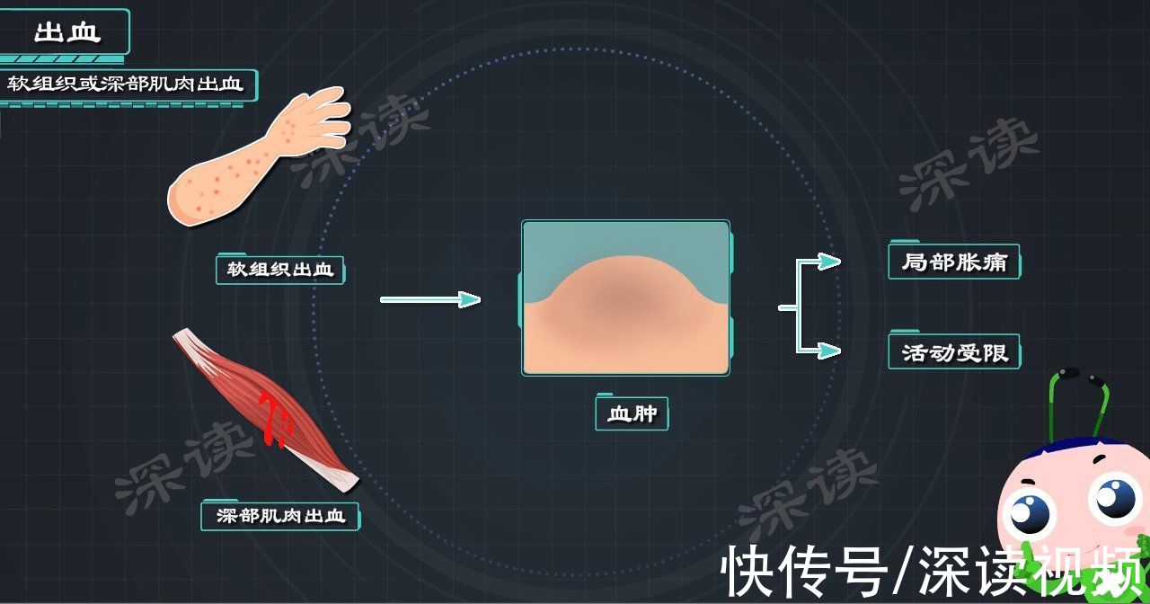 血友病|一碰就出血？出血难止住？让人脆弱不堪的血友病，都有啥症状？