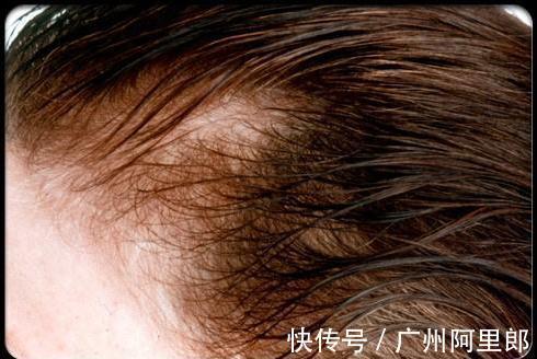 柠檬水|头皮油、头发掉得快,原来是因为它!