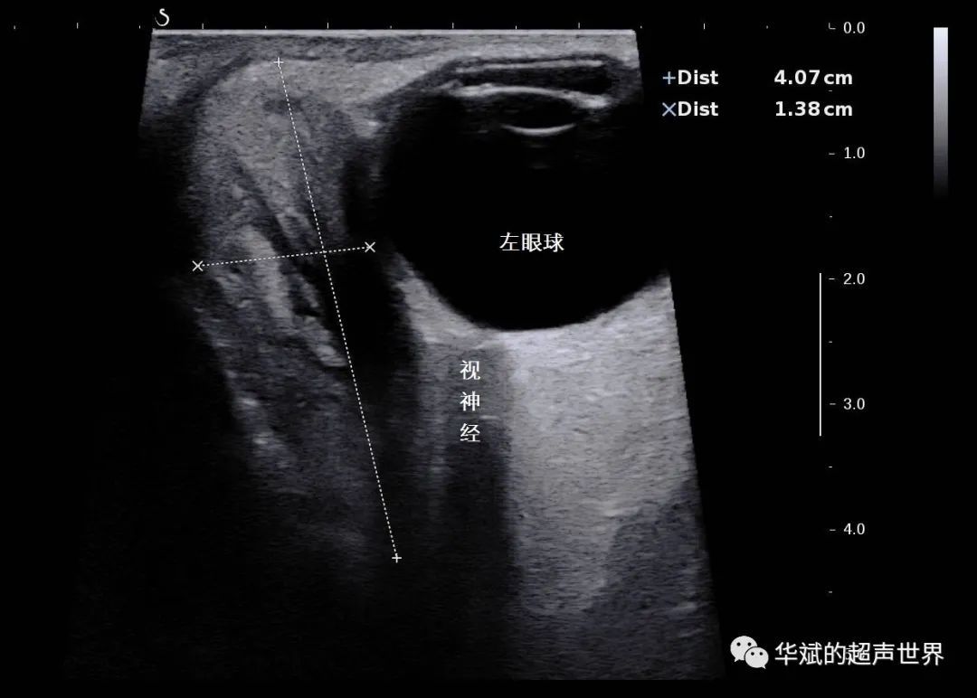 类风湿性关节炎|典型病例?眶内炎性假瘤