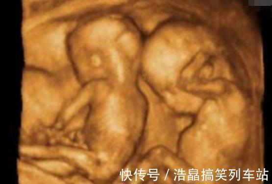 双胞胎|双胞胎被查出“畸形”，准妈妈不顾劝阻坚持生下，是自私还是母爱