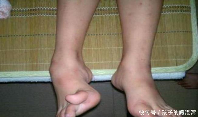 鞋子|4岁孩子双脚变畸形,原因出在''这种鞋子''上,父母真要长点心了