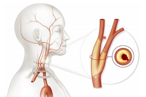 斑块|如何预防动脉粥样硬化，预防颈动脉斑块医生介绍3个有效办法
