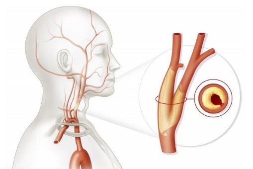 斑块|如何预防动脉粥样硬化,预防颈动脉斑块医生介绍3个有效办法