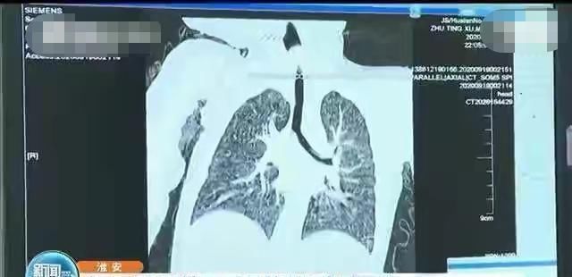 喂食|粗心家长喂食八个月婴儿排骨，导致窒息婴儿命悬一线