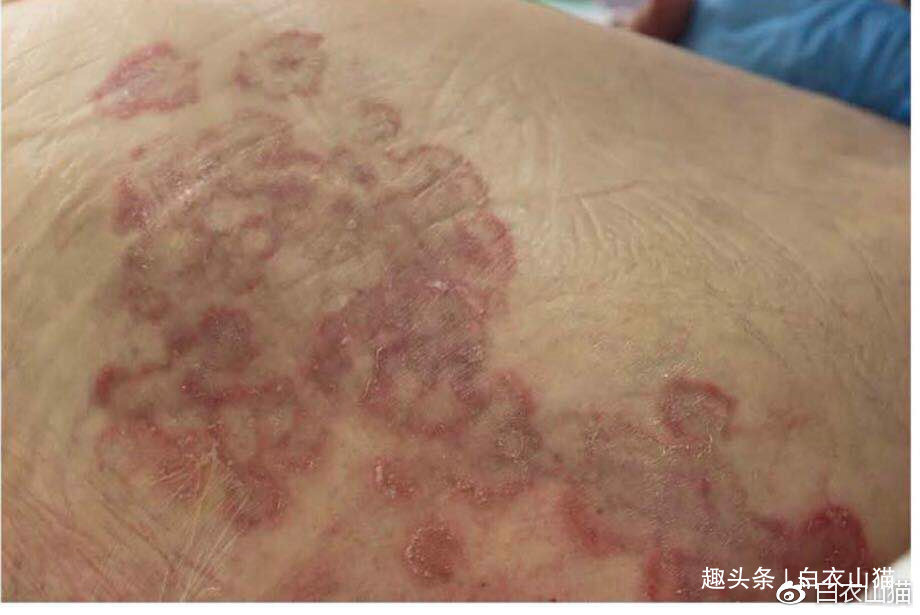 病人|注意,如有人出现这种皮纹,往往提示他内脏有癌!