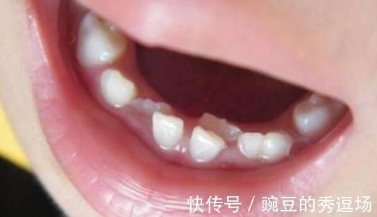 恒牙|孩子乳牙整齐漂亮，换牙后却越来越歪？可能是这几点没做好