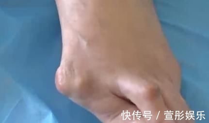 拇指 爱穿高跟鞋的女性一定要小心,拇指外翻堪比“裹脚”!不可忽视