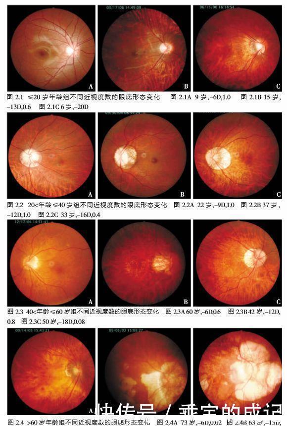玻璃膜|近视超过600+?我建议你看看自己的眼底,绝对惊恐!