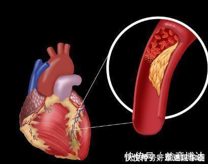 下肢|血管狭窄会有五个“标志”,超过三个以上,“暗示”血栓正在形成