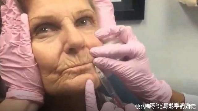 神奇|玻尿酸到底多神奇80岁外国老奶奶亲自实验,一小时后惊艳全场!