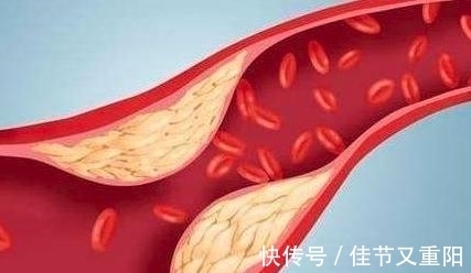 视网膜|有高血压却不管不顾,5大并发症悄然腐蚀你的身体!有症状就迟了