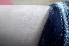 瘙痒|秋冬皮肤干又痒，为啥有人一脱秋裤像“下雪”？