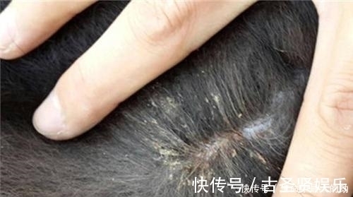 虱子|为什么头上会长虱子?真相原来如此,看完恍然大悟