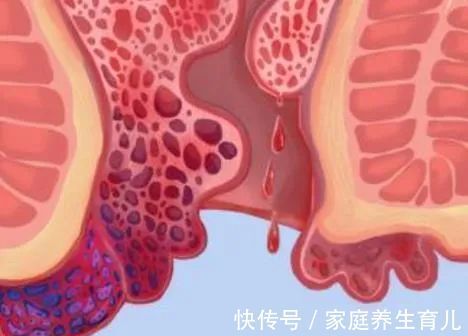 慢性疾病|痔疮患者去痔指南来了,没想到它才是痔疮杀手!从此还你健康“菊花”!