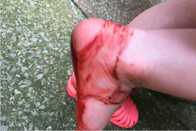 果冻鞋|前有“洞洞鞋”,后有“果冻鞋”,血的教训告诉你为啥别给孩子穿