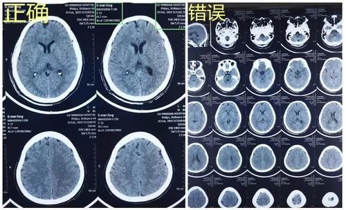  翻拍|如何留影像资料？如何翻拍影像学检查片子？