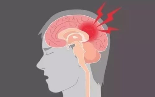 脑出血|高血压达到多少,会引发脑出血?提醒:尽量不要超过这个范围