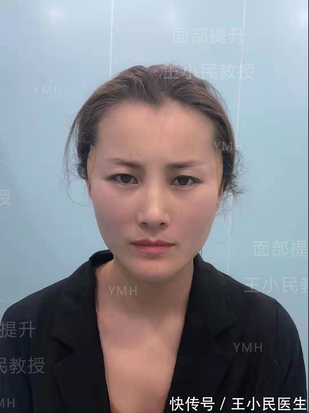 法令纹 王小民教授:40多岁做小拉皮手术,术后效果怎么样?